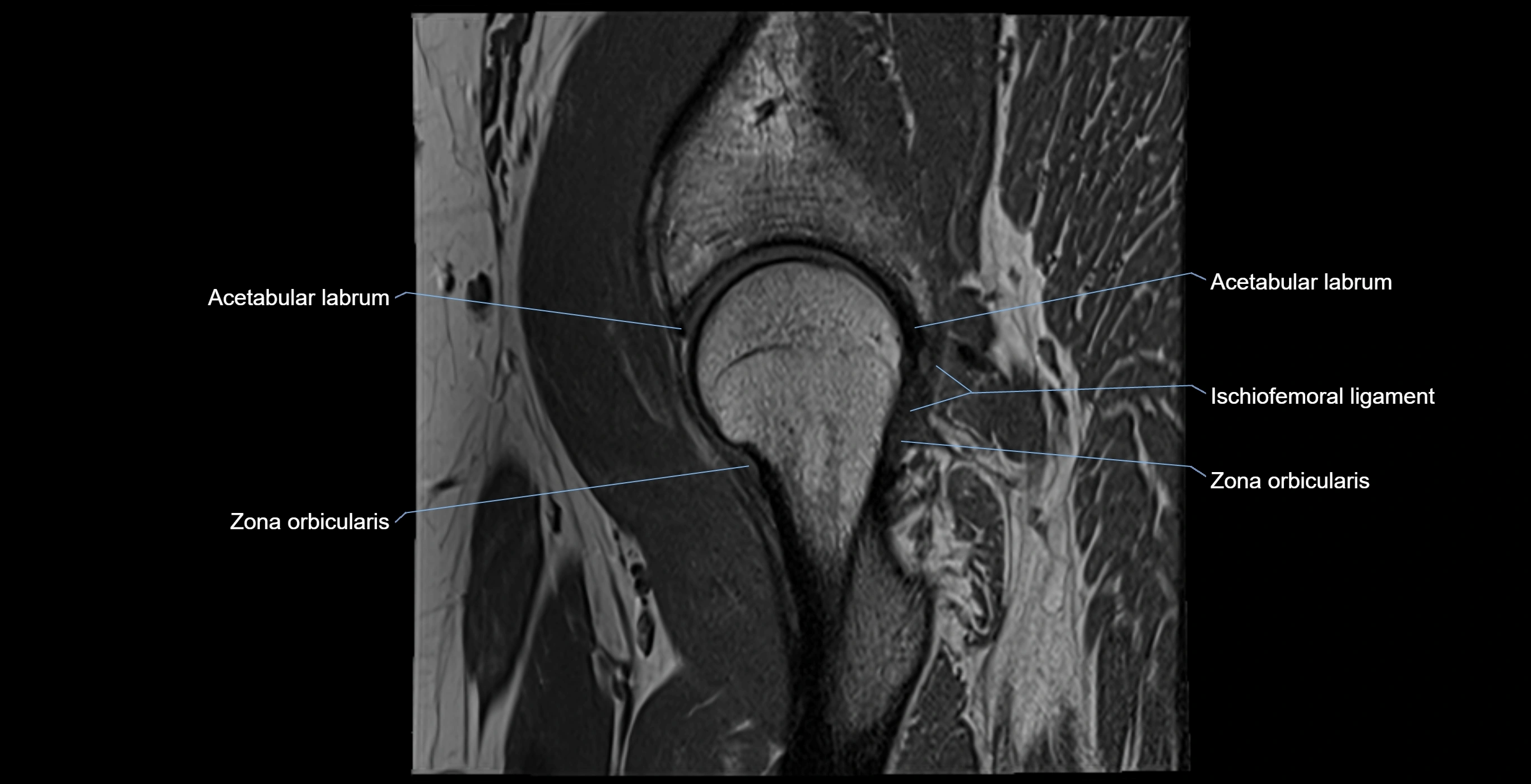 MRI Hip ligaments sagittal cross sectional anatomy 3T  radiology  image-img-00001-00011.webp